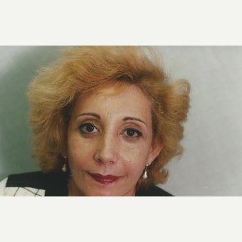Eyelid rejuvenation-Chemical Peel and Lower Blepharoplasty after 1645252