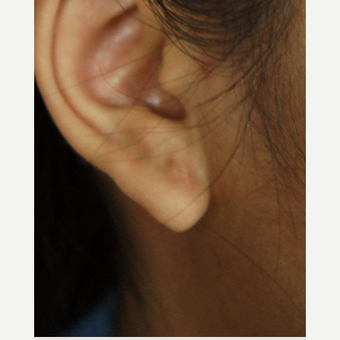 18-24 year old woman treated with Ear Lobe Surgery after 3244959