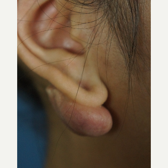 18-24 year old woman treated with Ear Lobe Surgery before 3244959