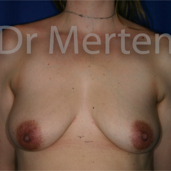 35-44 year old woman treated with Breast Augmentation before 3552644