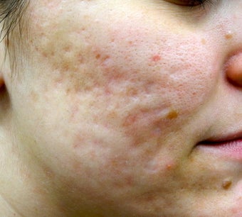 Filling up acne scars before 1442214