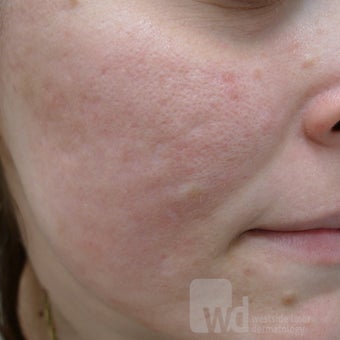 Filling up acne scars after 1442214