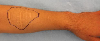 Self-harm scars. Before and after "dermabrasion and thin skin grafting". before 1359013