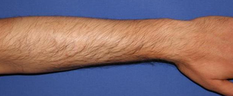 Self-harm scars. Before and after "dermabrasion and thin skin grafting". after 1359013