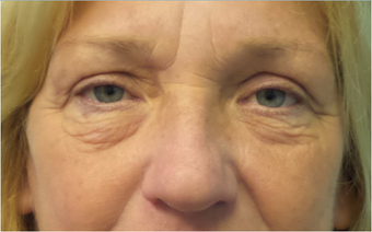 Lower blepharoplasty for eye bags before 3634057