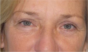 Lower blepharoplasty for eye bags after 3634057
