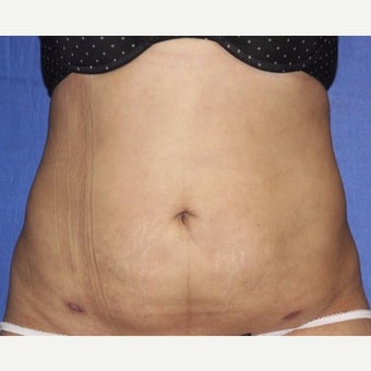 35-44 year old woman treated with Laser Liposuction after 2037051