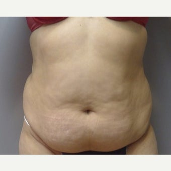 35-44 year old woman treated with Laser Liposuction before 2037051