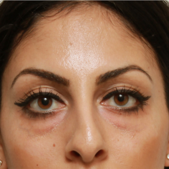 25-34 year old woman treated with Eye Bags Treatment before 3566697