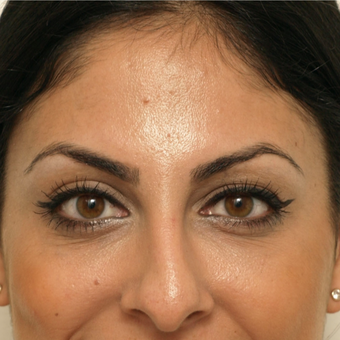 25-34 year old woman treated with Eye Bags Treatment after 3566697