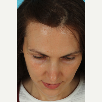 25-34 year old woman treated with Revision Rhinoplasty after 3630190