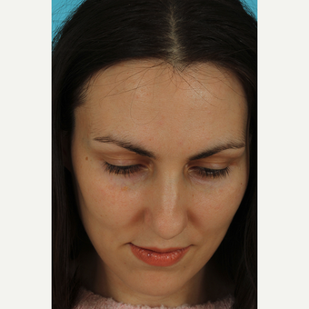 25-34 year old woman treated with Revision Rhinoplasty before 3630190