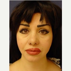 35-44 year old woman treated with Fat Transfer before 2079271