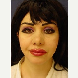 35-44 year old woman treated with Fat Transfer after 2079271