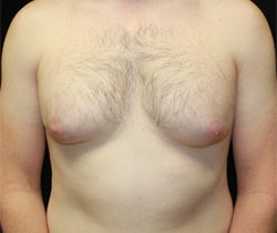 Coolsculpting male chest (unilateral) before 1201370