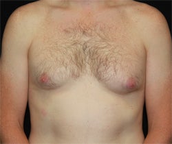 Coolsculpting male chest (unilateral) after 1201370