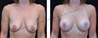 Breast Lift with Implants before 1392156