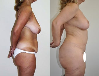 Mommy makeover in a 48 year-old female after 957639
