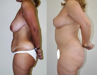 Mommy makeover in a 48 year-old female 957639