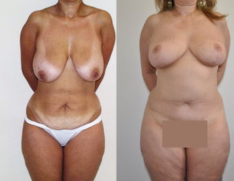 Mommy makeover in a 48 year-old female before 957639
