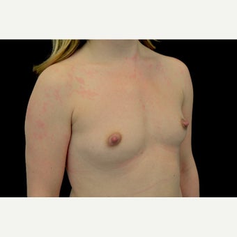 Before & After 300cc Silicone Gel Implants before 1659670