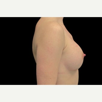 Before & After 300cc Silicone Gel Implants 1659670