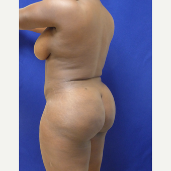 35-44 year old woman treated with Brazilian Butt Lift after 3344831