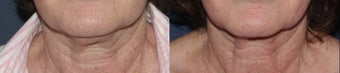 Ulthera Neck | Before and After before 1033996
