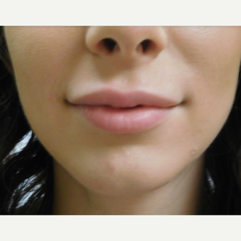 25-34 year old woman treated with Restylane Lyft before 3710828