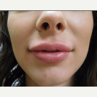 25-34 year old woman treated with Restylane Lyft after 3710828