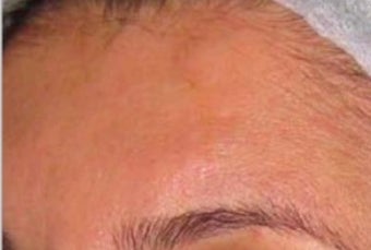 25-34 year old woman treated with Scar Removal after 1789347