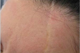 25-34 year old woman treated with Scar Removal before 1789347