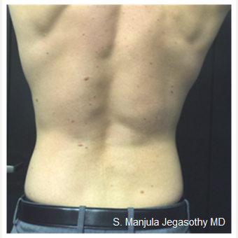 Love Handles Melted with Kybella® Injections after 2464132