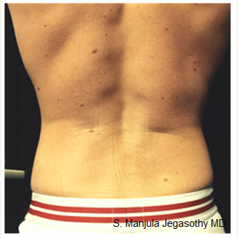Love Handles Melted with Kybella® Injections before 2464132