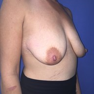 Augmentation Mastopexy before 3729139