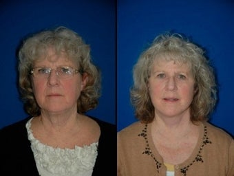 58 year old woman treated with Facelift before 3004834