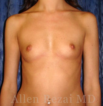 Bilateral Breast Augmentation - Pre- & 16 Months Post-op before 2255222