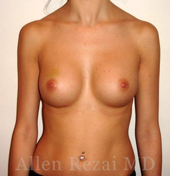 Bilateral Breast Augmentation - Pre- & 16 Months Post-op after 2255222