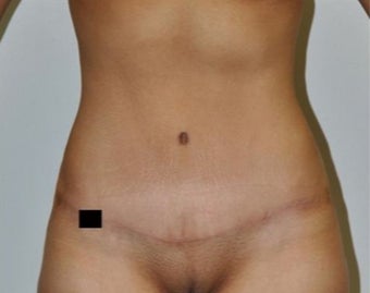 25-34 year old woman treated with Tummy Tuck after 1820637