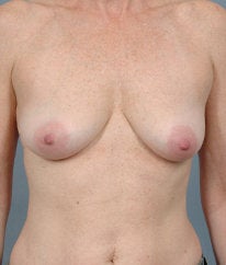 Breast Augmentation before 476666