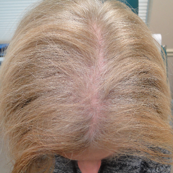 Post PRP results in a 51 year female patient. before 2732218