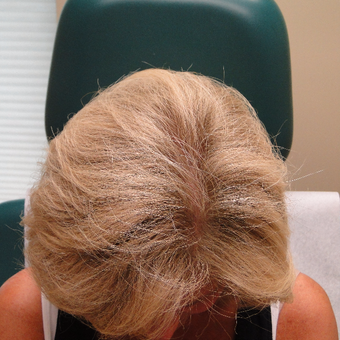 Post PRP results in a 51 year female patient. after 2732218