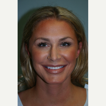 35-44 year old woman treated with Neck Lift after 3569582