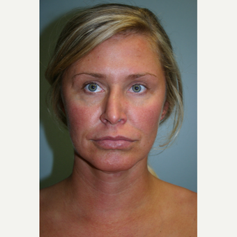 35-44 year old woman treated with Neck Lift before 3569582