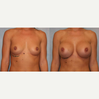 25-34 year old woman treated with Breast Augmentation before 3440378
