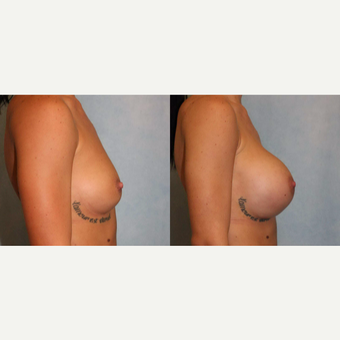 25-34 year old woman treated with Breast Augmentation after 3440378