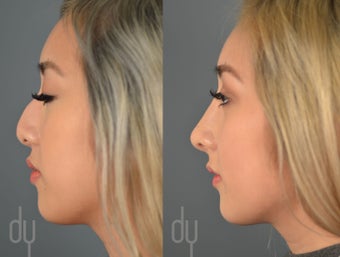 18-24 year old woman treated with Asian Rhinoplasty before 2465768