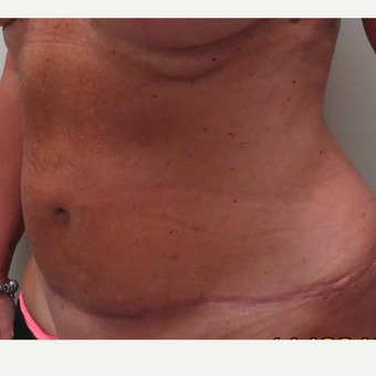 Tummy Tuck for this 61 Year Old Woman after 3092668