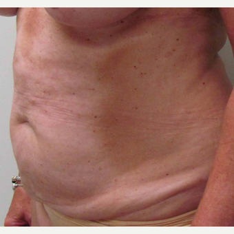 Tummy Tuck for this 61 Year Old Woman before 3092668