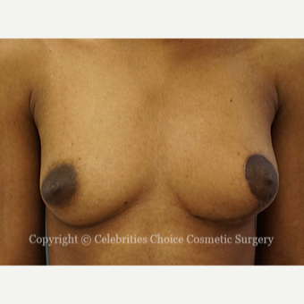 25-34 year old woman treated with Breast Reconstruction after 3768555